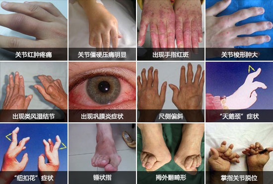 贵阳强直医院类风湿症状.jpg