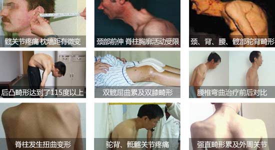 贵阳强直医院强直性脊柱炎引起脊椎弯曲、关节疼痛.jpg