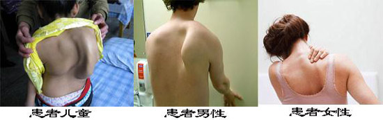 贵阳强直医院不同性别、年龄都有可能患有强直性脊柱炎.jpg