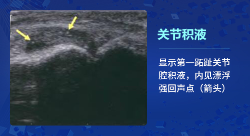 500-6关节积液.jpg